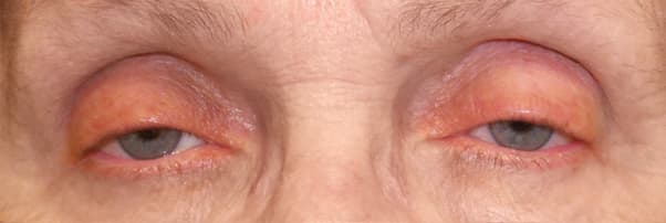 Acquired ptosis — drooping of both upper eyelids in an older adult